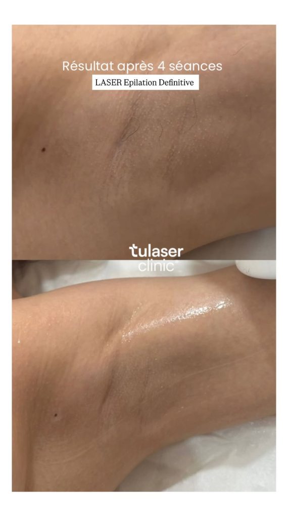 Avant/après épilation au laser