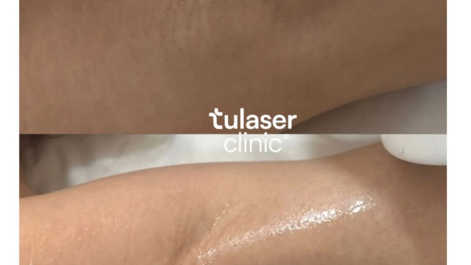 Avant/après épilation au laser