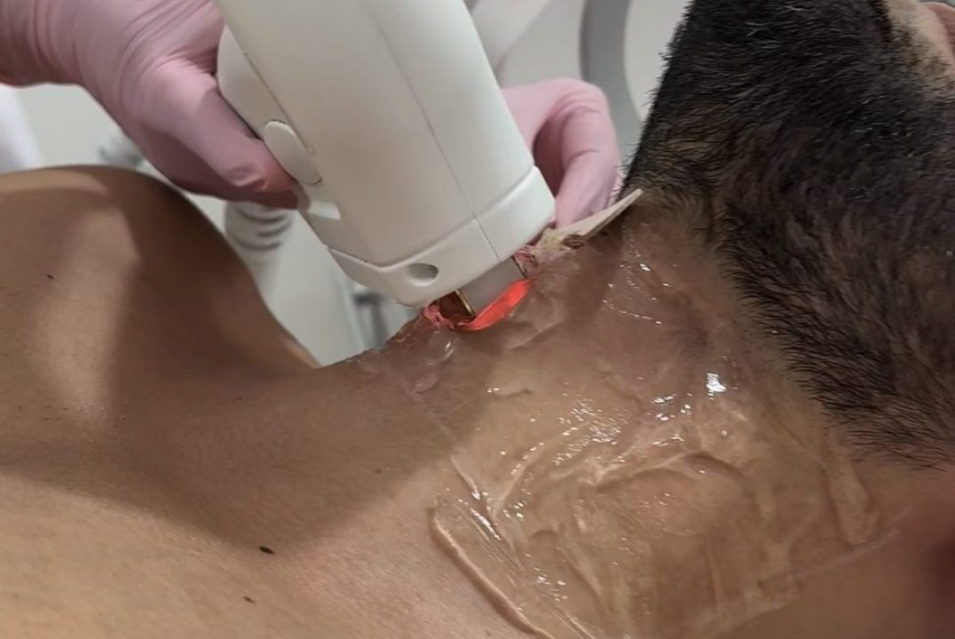 Épilation laser Homme Casablanca