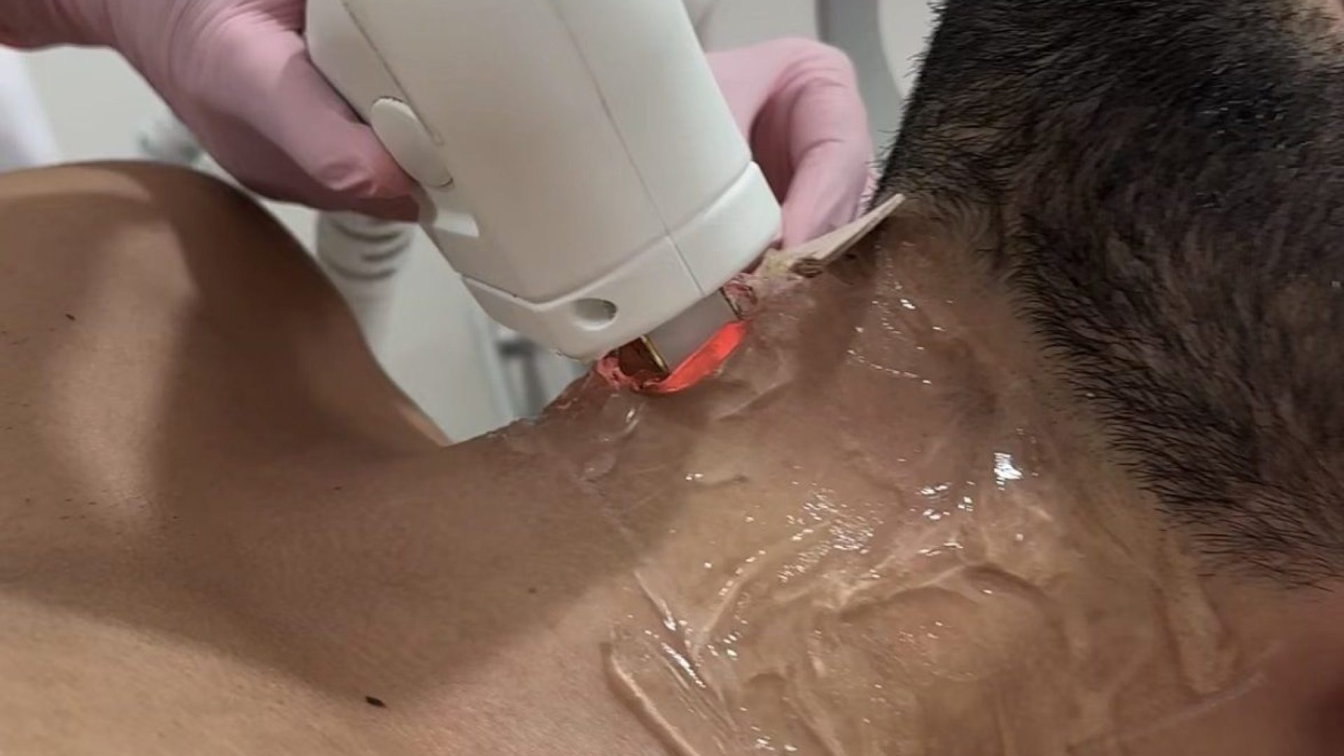 Épilation laser Homme Casablanca