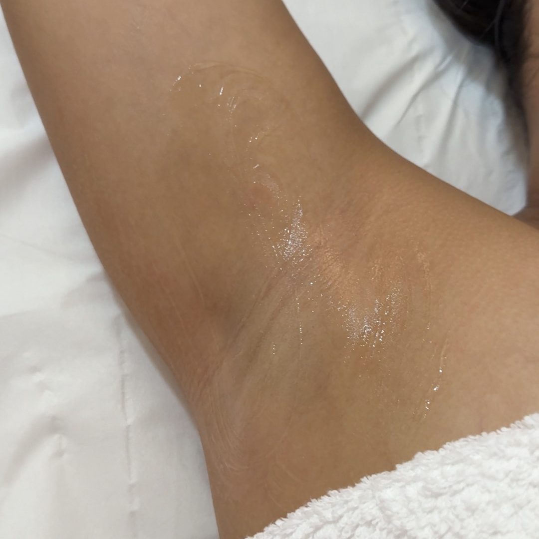 avant/après épilation laser