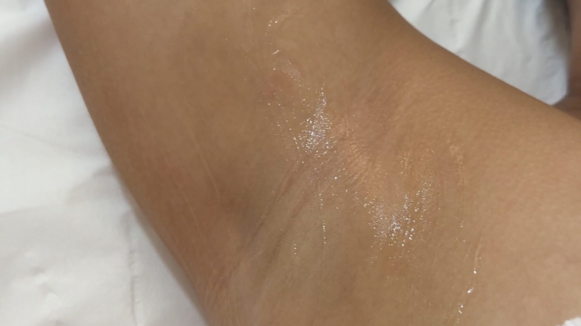 avant/après épilation laser